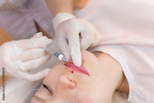 The cosmetologist pushed the needle from the syringe into the girl s lips to the very base trying to evenly inject hyaluronic acid. The blood droplets act as a result of the previous injections