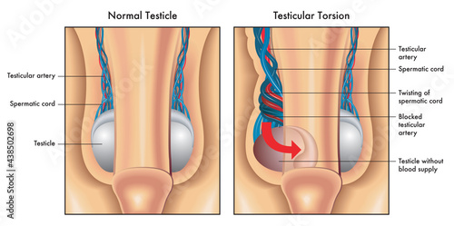 Medical illustration shows a normal testicle and one affected by testicular torsion, with annotations. photo