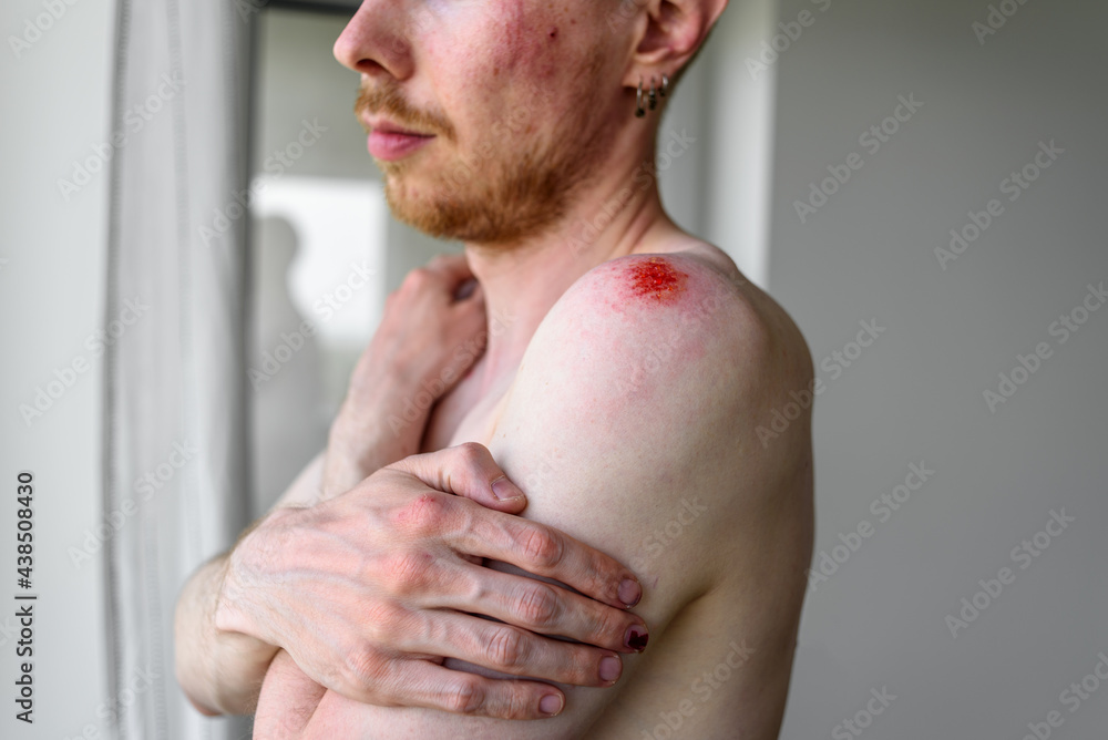 Naklejka premium Man with many wounds on skin hugging yourself. Domestic violence, accident, fight concept