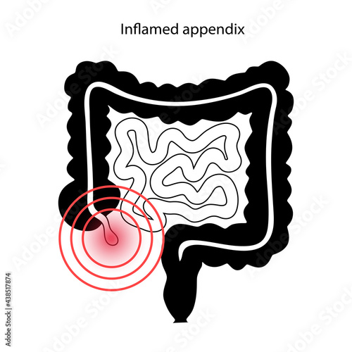 Appendix pain concept