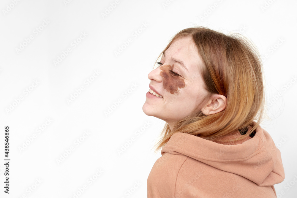 Side view of happy young lady in hoodie with brown birthmark on face with closed eyes on white background in light studio Side view of happy young lady in hoodie with brown birthmark on face with closed eyes on white background in light studio