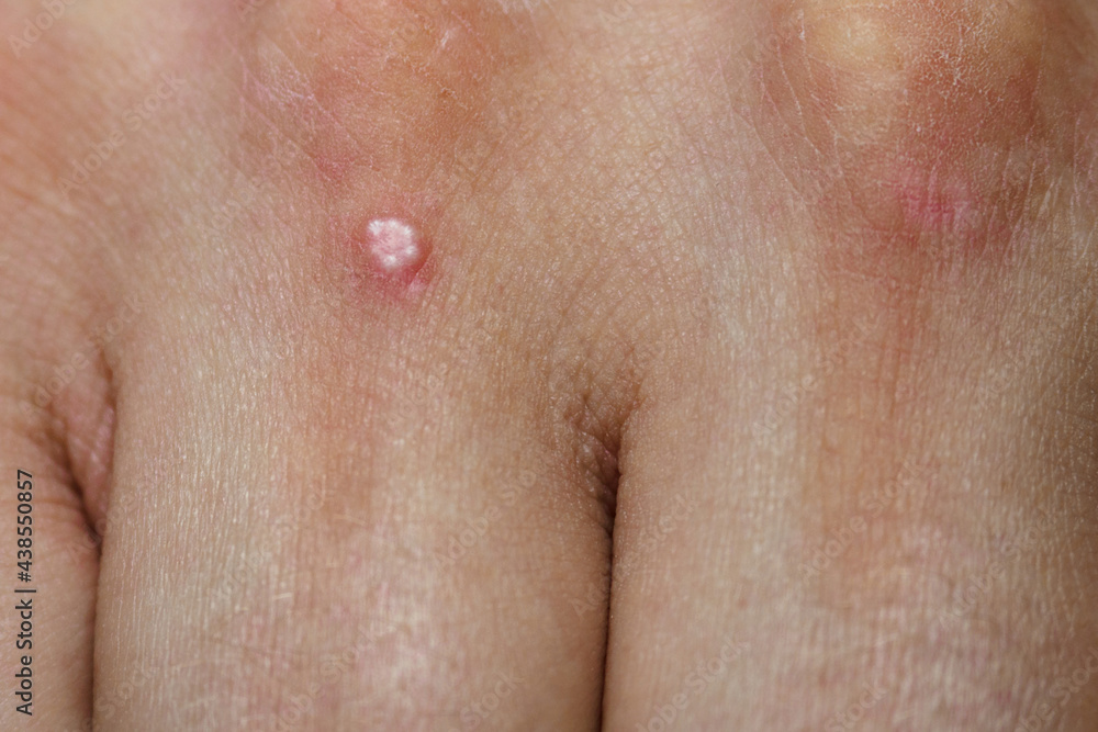 Fototapeta premium White dots on the skin on the hands together.