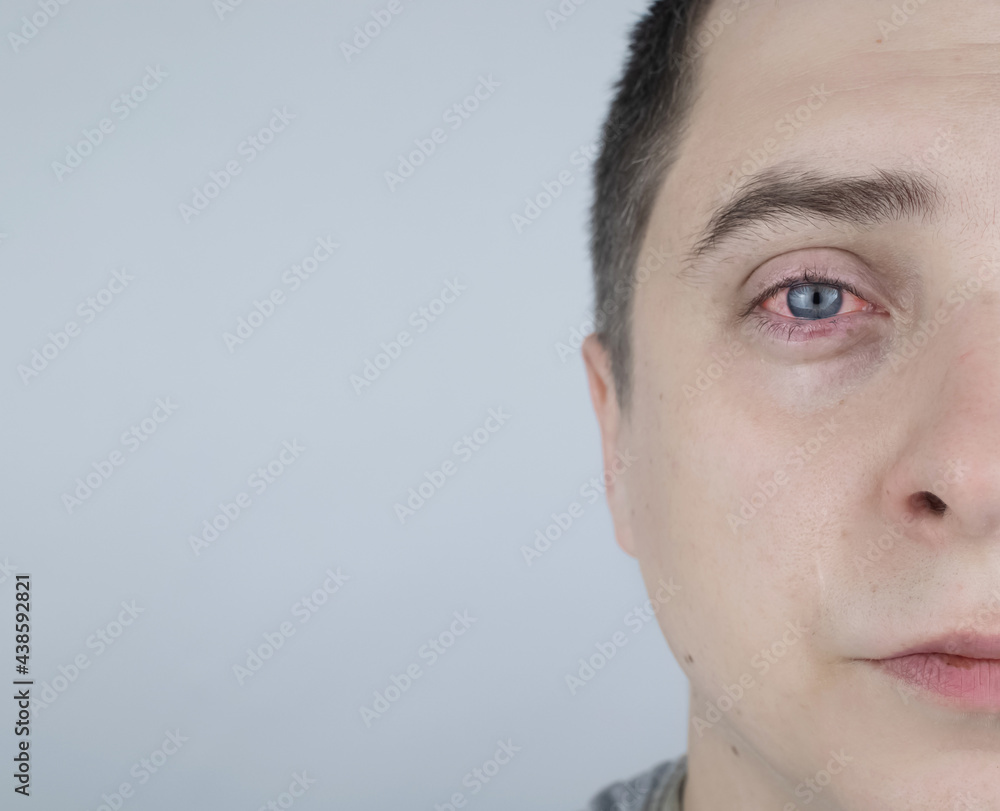 Fototapeta premium Close up of two annoyed red blood eyes of male affected by conjunctivitis or after flu, cold, allergy. Copy space for advertisement. Tired eyes after working at the computer. Close-up videos and macro