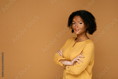 Skin abnormalities. Skincare with vitiligo and abnormal spots human body, female portrait on beige background photo