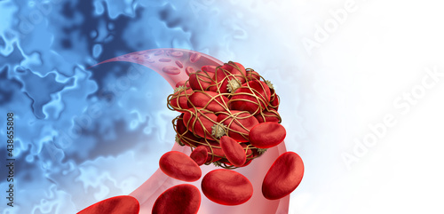 Blood clots health risk or thrombosis medical illustration concept symbol as a group of human blood cells clot clumped together by sticky platelets and fibrin as a blockage in an artery or vein photo
