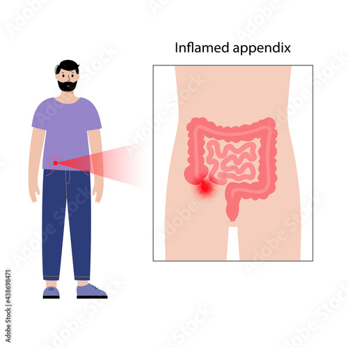 Appendix pain concept