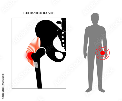 Bursitis inflammation concept
