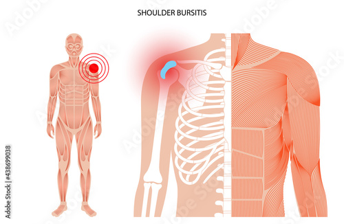 Bursitis inflammation concept