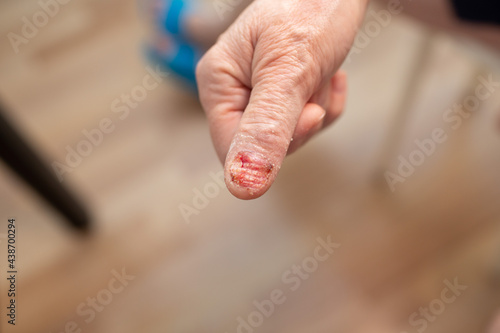 Tableau sur toile Felon whitlow on hand finger toe injured to lose nail
