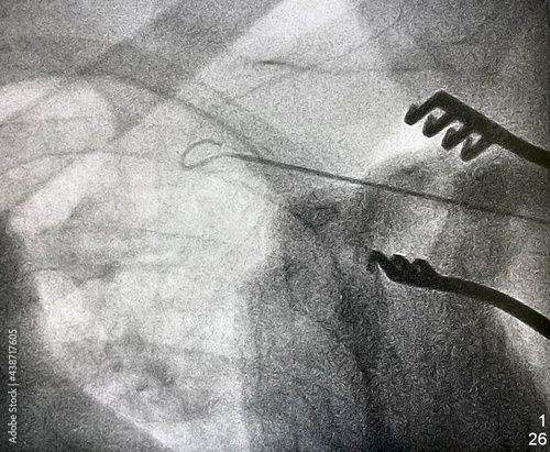 Obraz na plátně X ray image during permanent pacemaker implantation procedure.