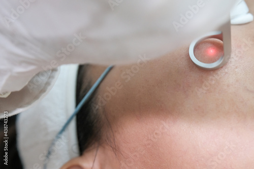 Close up of a woman getting laser face treatment procedure in medical salon center. Skin rejuvenation and beauty concept