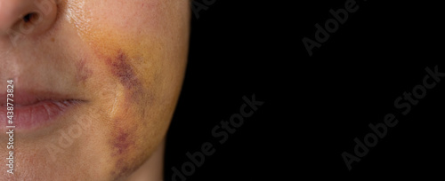 Unrecognizable woman face with bruises against black background photo