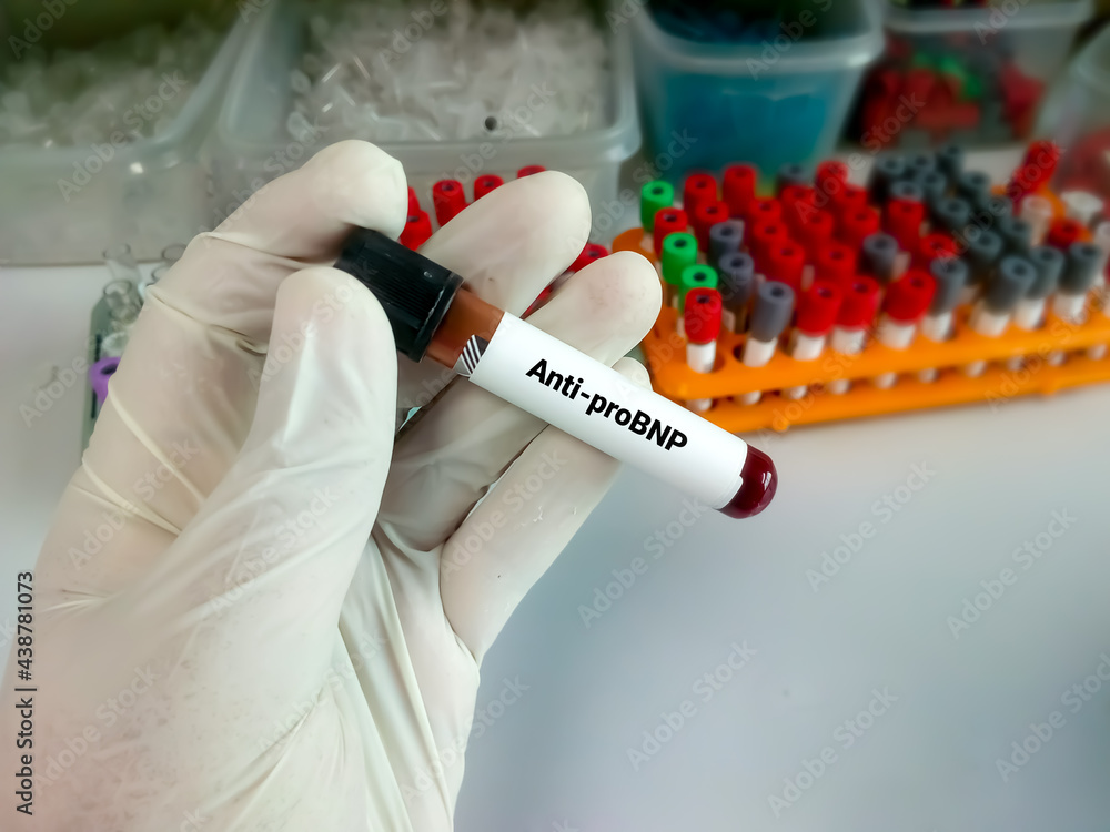 Blood sample for Nterminal pro Btype natriuretic peptide or NTproBNP