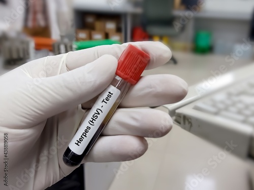 Biochemist or doctor holds blood sample for Herpes test, Herpes simplex virus (HSV). Medical test tube in laboratory background.