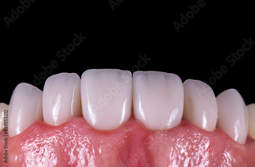 press ceramic crowns veneers and inlays