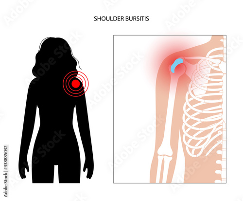 Bursitis inflammation concept