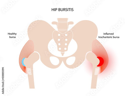 Bursitis inflammation concept