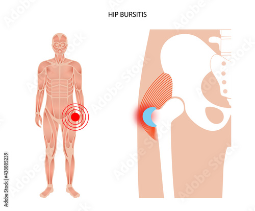 Bursitis inflammation concept