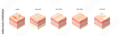set different types skin layers cross-section of human skin structure skincare medical concept flat horizontal