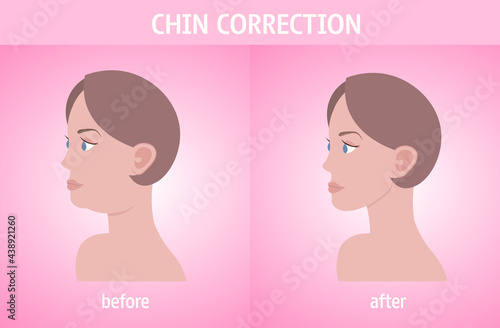 woman face before and after double chin fat correction procedure aesthetic medicine concept horizontal portrait