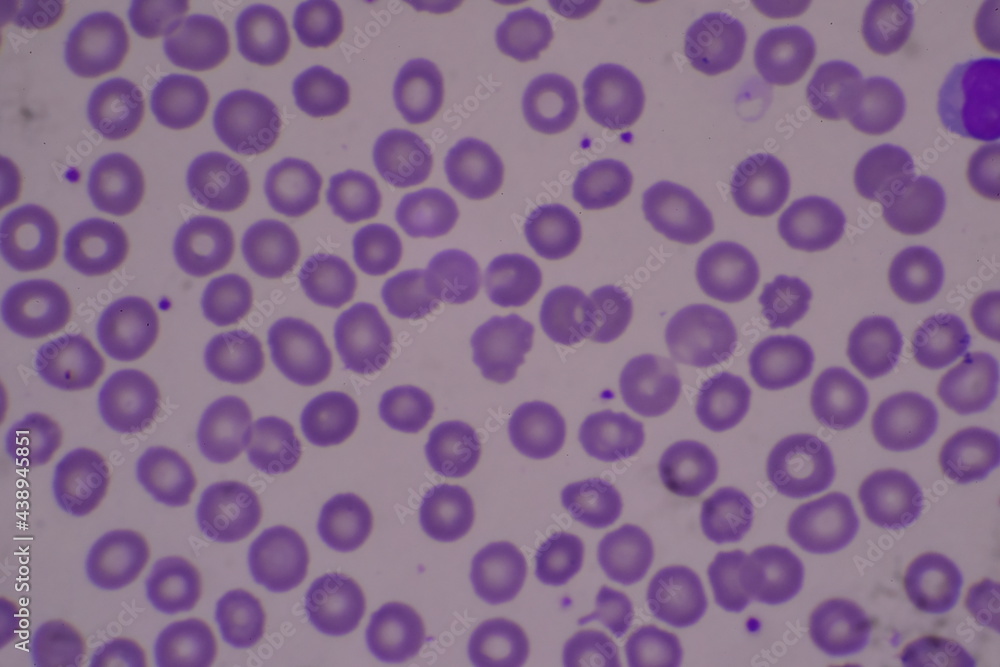 Adequate of platelet in blood smear. Adequate of platelet in blood smear.