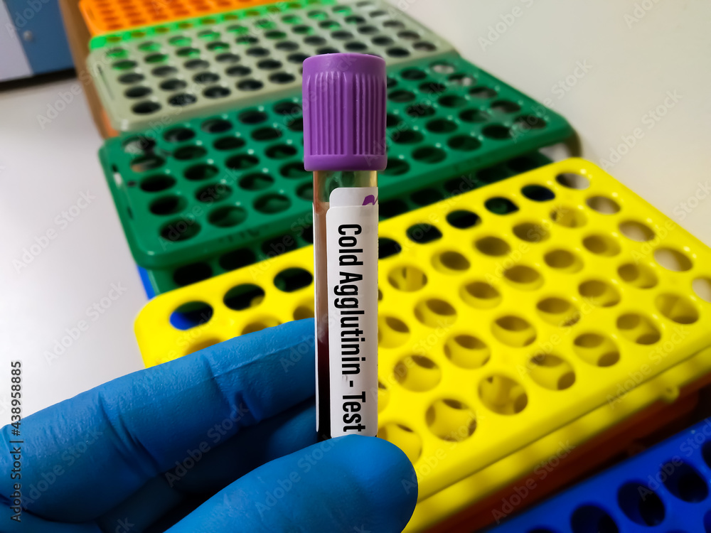 Blood sample tube for cold agglutinin disease (CAD), autoimmune