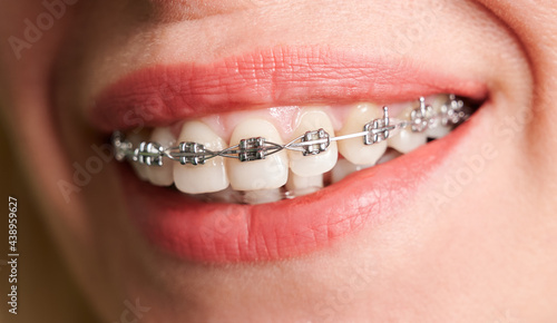 Close up of female patient showing white straight teeth with orthodontic brackets. Woman demonstrating results of dental braces treatment. Concept of dentistry, dental care and orthodontic treatment.