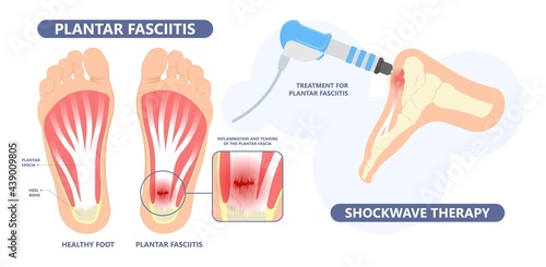 Plantar Fasciitis Heel pain run foot bone toes tear strain sport injury arch Shock Wave flat feet fallen pes planus Tendon tight hollow cavus high curved spur bony ankle band torn photo