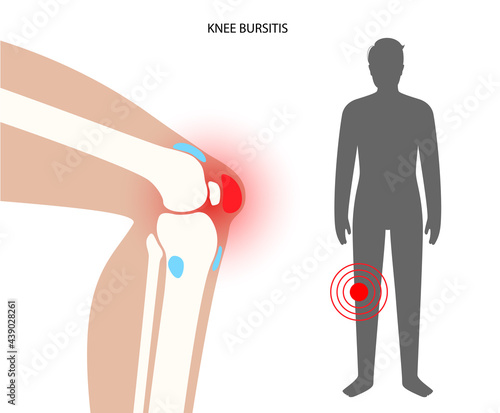 Bursitis inflammation concept