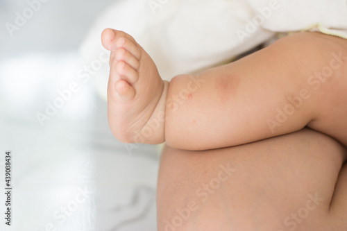 Infected itchy blisters on the legs of a child. Health concepts.