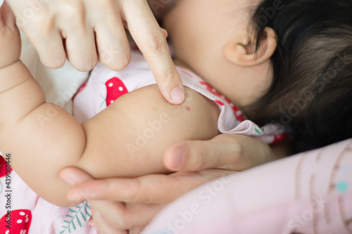 BCG vaccination mark is on infant shoulder, close up view with mother hands,Close up baby after get vaccination done, 
