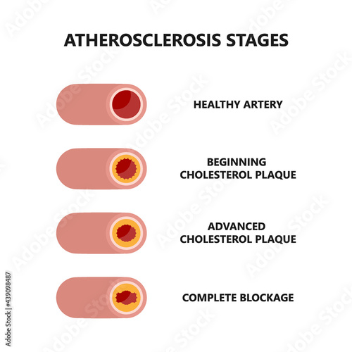Stages of atherosclerosis. Cholesterol plaque formation and growth.