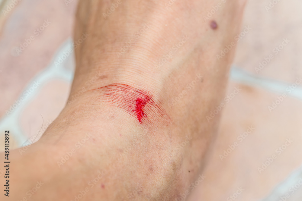 Injuries from falling in the garden. A man showing a lesion on his foot. Arm is wound from a knife. Figure cut on the skin with blood drops. Accident wound marks on the foot side Injuries from falling in the garden. A man showing a lesion on his foot. Arm is wound from a knife. Figure cut on the skin with blood drops. Accident wound marks on the foot side