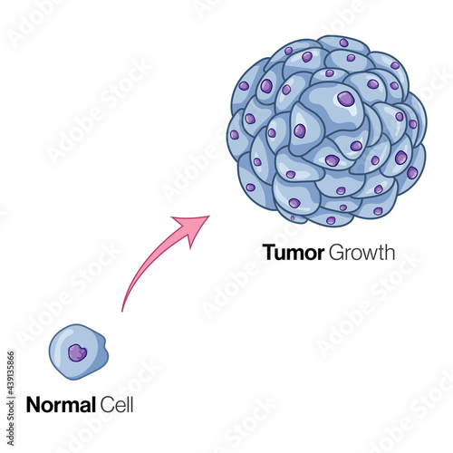 Tumor Growth from normal cell Illustration