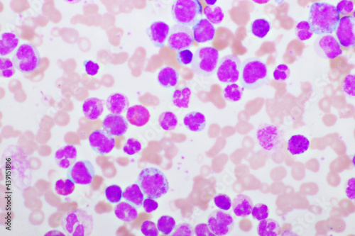 Chronic myeloid leukemia cells or CML, analyze by microscope, original magnification 400x