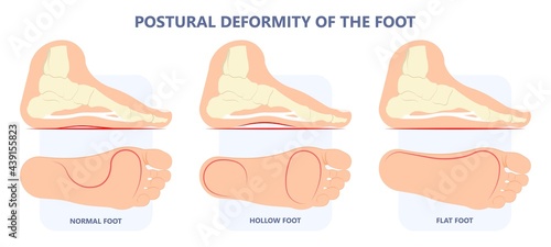 Plantar Fasciitis Heel pain run foot bone toes tear strain sport injury arch Shock Wave flat feet fallen pes planus Tendon tight hollow cavus high curved spur bony ankle band torn