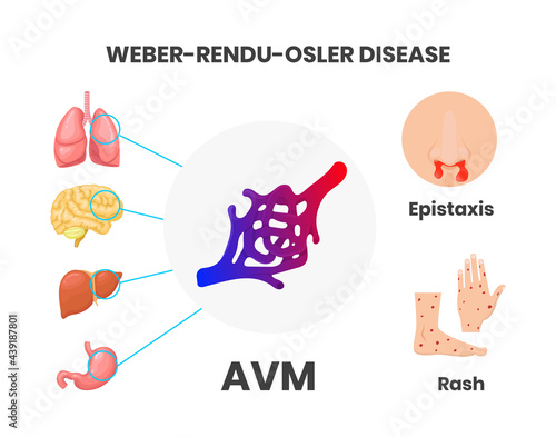Osler-Rendu-Weber disease signs and symptoms