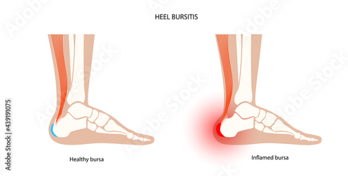 Bursitis inflammation concept
