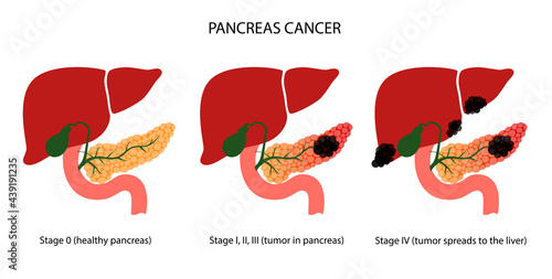 Pancreas disease and cancer