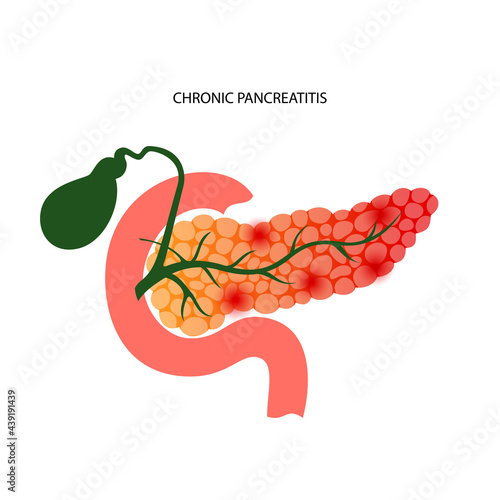 Pancreas disease concept