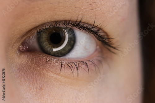 An eye with a green iris and a spot obtained as a result of retinopathy.