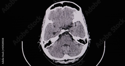 CT brain cine scan of a patient with left side hemiplegia showing large intracerebral hemorrhage and hematoma at right basal ganglia. Diagnostic CT footage. photo