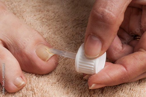 Ταπετσαρία Woman applies treatment to cure toenail fungus (onychomycosis)