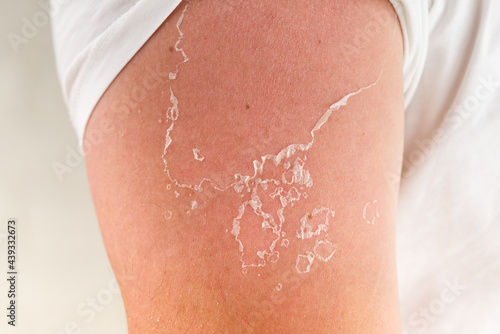 Fotografia peeling of skin after burned by sunlight