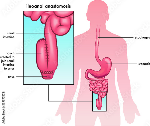 Medical illustration of ileoanal anastomosis surgery, with annotations.