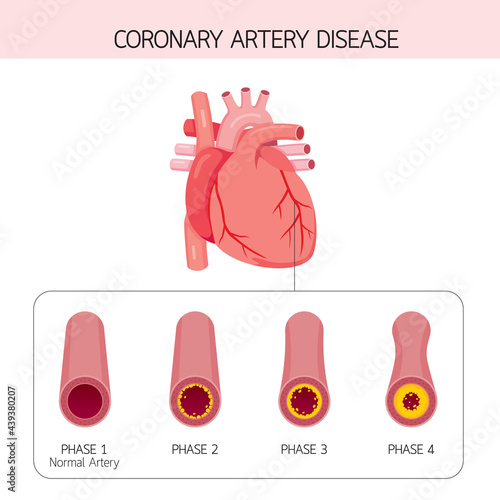 Coronary Artery Disease Narrowing Or Blockage Of Coronary Arteries, Condition Caused By Build-up Of Cholesterol And Fatty Inside Arteries photo