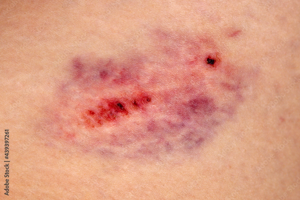 Close-up on the bruise on the skin of the leg of an injured woman. Close up on a bruise on the skin of an injured woman's leg. Gender Violence Concept - obrazy, fototapety, plakaty 