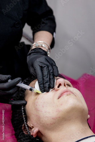 Cosmetologist doctor is making multiple injections biorevitalization with hyaluronic acid in woman face skin  closeup. Woman on the procedure of mesotherapy injection