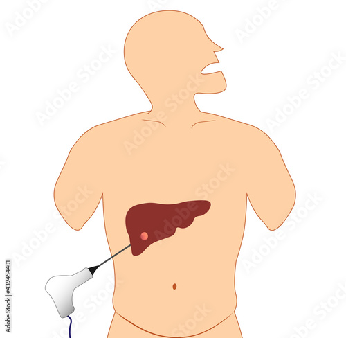 Liver Radiofrequency ablation (RFA) illustration. Liver cancer ablation. Needle ablation  photo