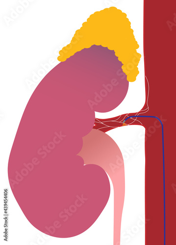 Photography Renal denervation illustration. RDN treatment for hypertension